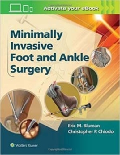 Minimally Invasive Foot and Ankle Surgery