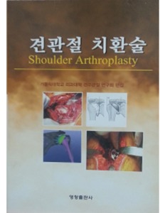견관절 치환술: Shoulder Arthroplasty